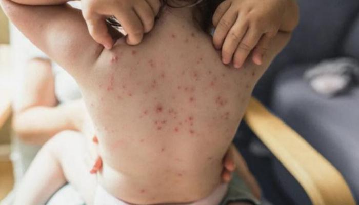 اكتشاف طريقة جديدة لانتقال فيروس جدري القرود