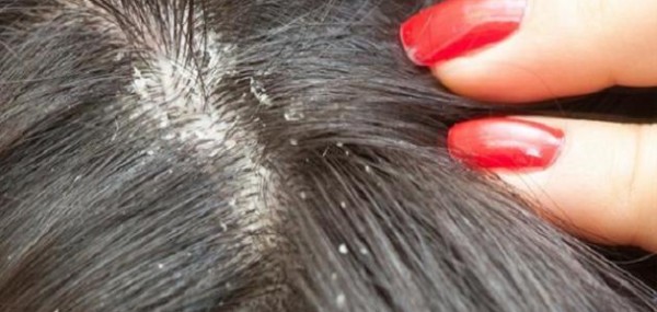وفاة طفلة تبلغ من العمر 7 سنوات.. والسبب مادة مركبة لعلاج القمل!