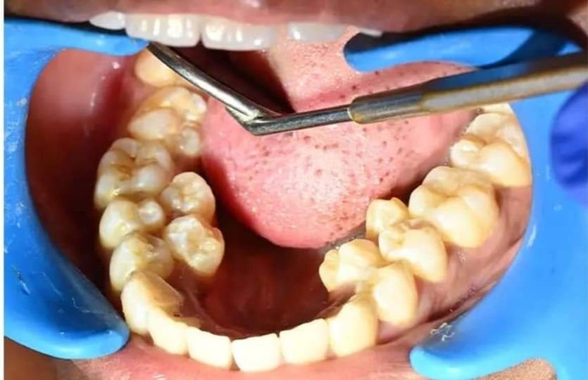 هندية تدخل موسوعة “غينيس” بعدد أسنانها