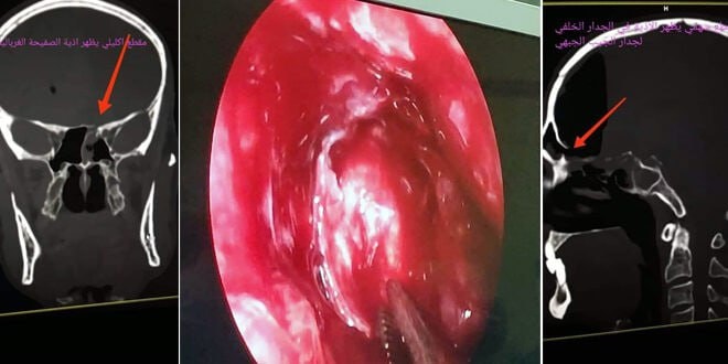 نجاح عمل جراحي نوعي في مشفى الباسل بطرطوس