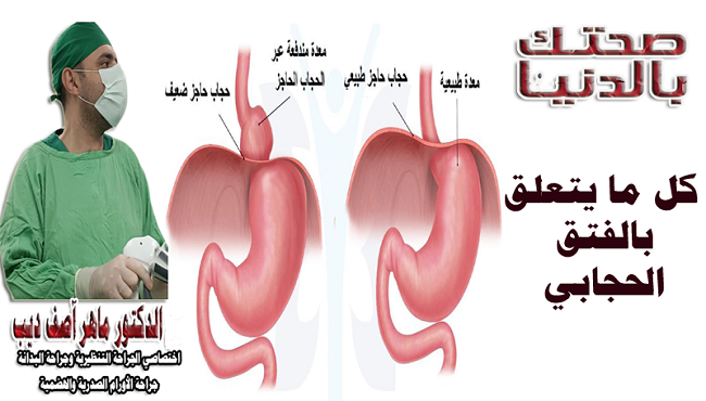 الفتق الحجابي (Hiatal Hernia)
